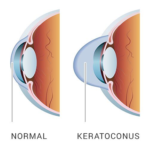 Test Your Keratoconus Knowledge: Seven Important Facts