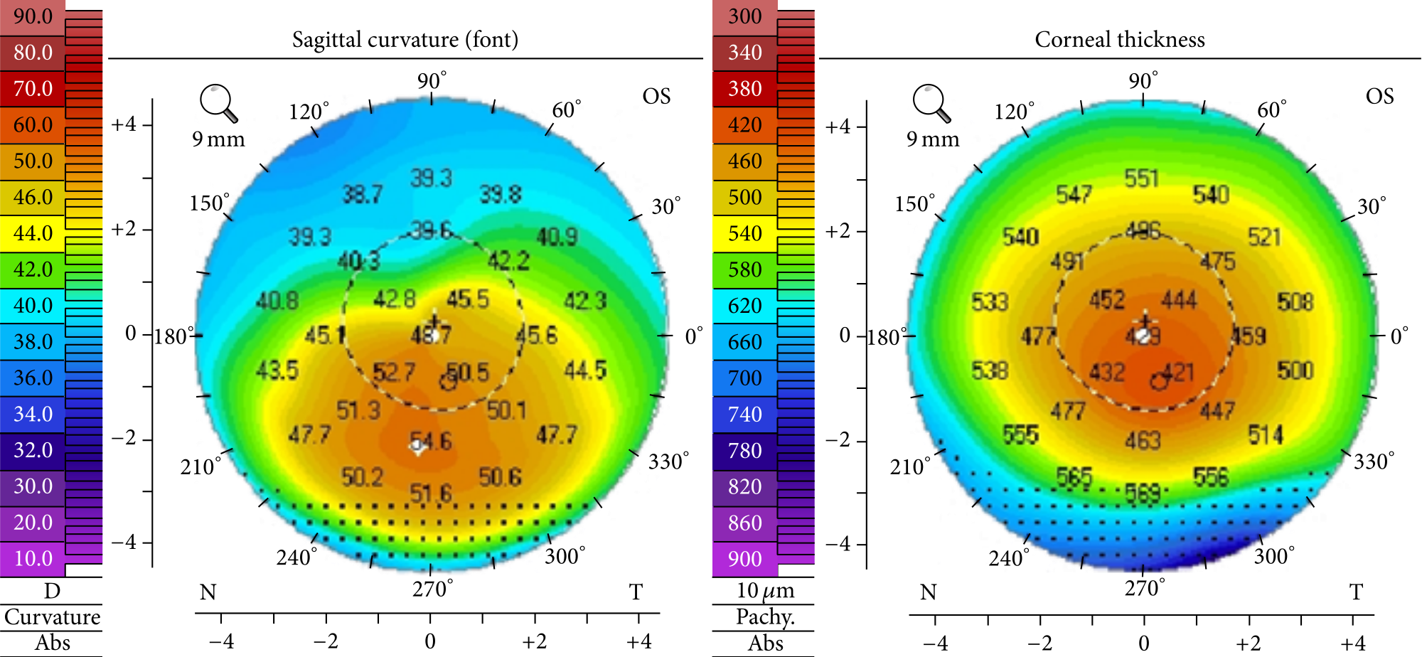 What To Know About Corneal Topography – Part 2