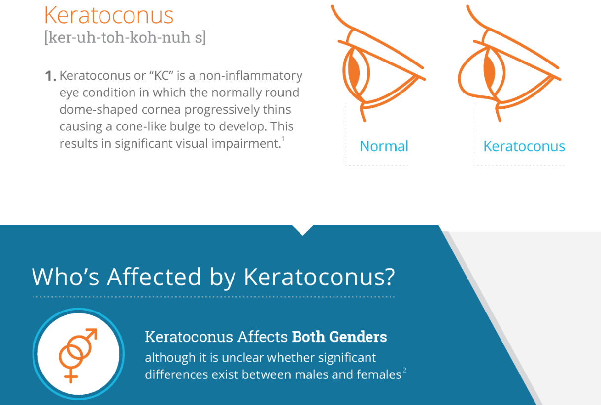 Infographic: Understanding Keratoconus & the Importance of Early Diagnosis