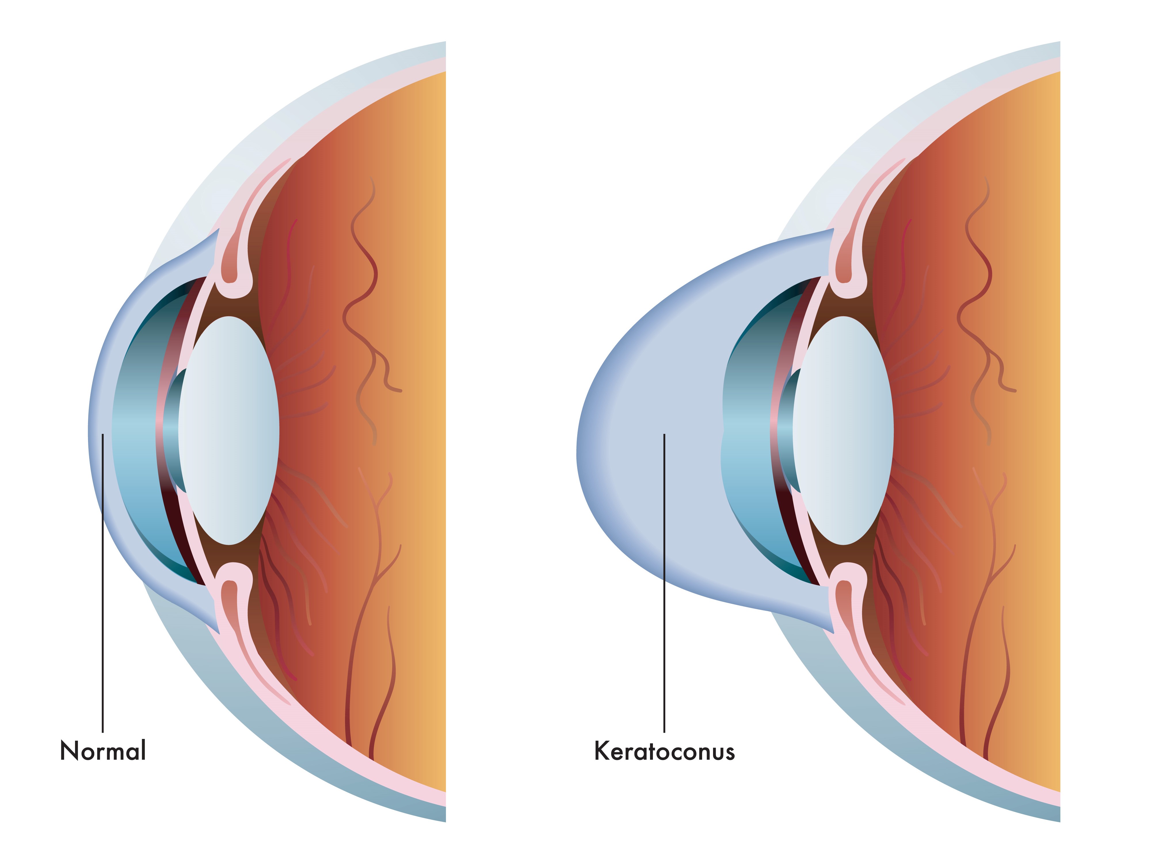 KC Experts on Early Signs of Keratoconus and Diagnosis
